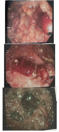 Familial adenomatous polyposis: A case report